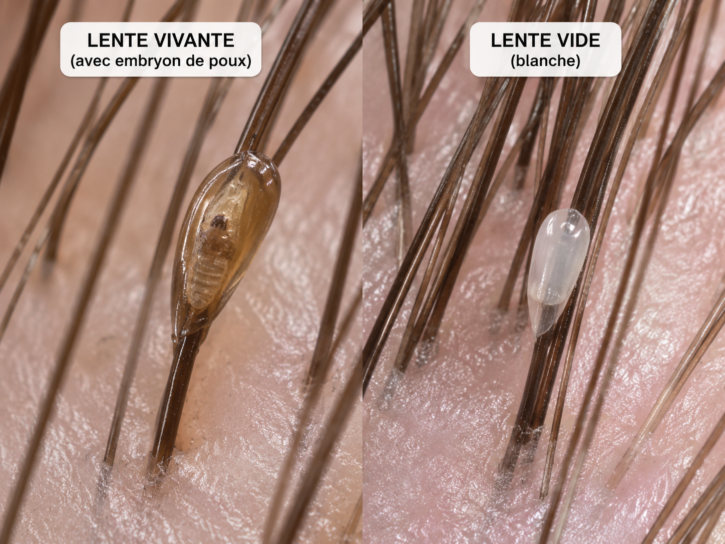 comment enlever les lentes